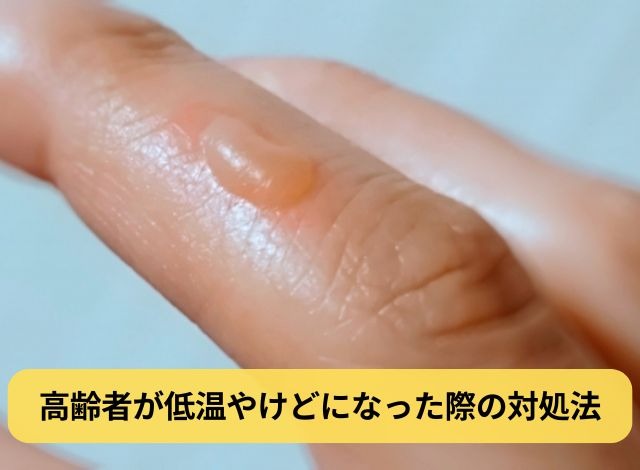 高齢者が低温やけどになった際の対処法