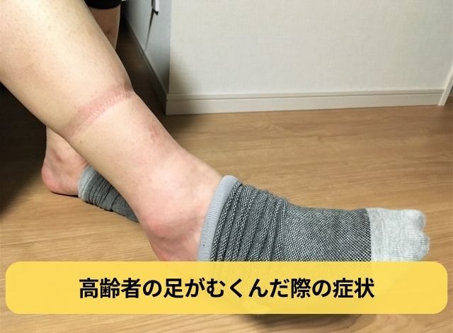 高齢者の足がむくんだ際の症状